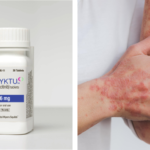 U.S. Food and Drug Administration (FDA) của Mỹ phê duyệt thuốc Sotyktu (deucravacitinib) của Bristol Myers Squibb để điều trị viêm khớp vảy nến hoạt động ở người lớn